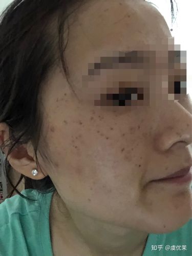 北京协和医院激光美容